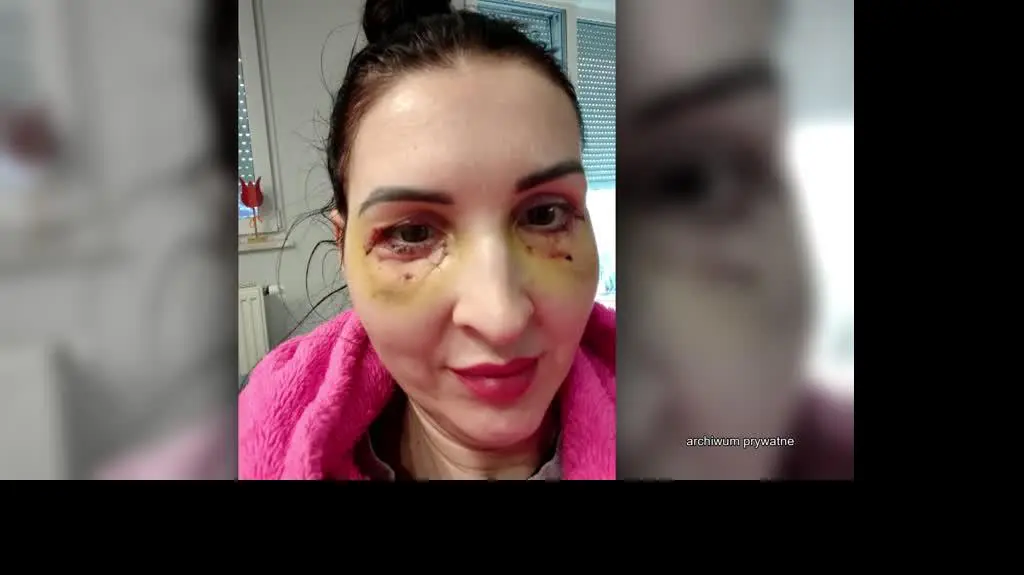 Ciemna strona nielegalnych zabiegów medycyny estetycznej