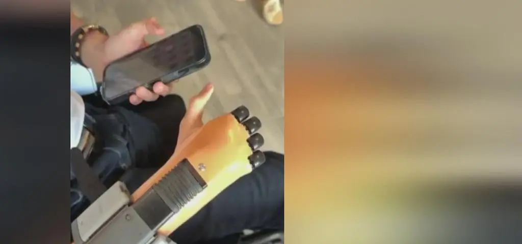Nowa ręka Dominika. Jak radzi sobie nastolatek?
